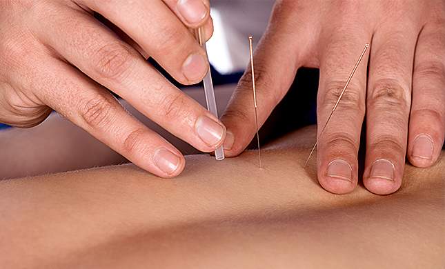 Acupuncture
