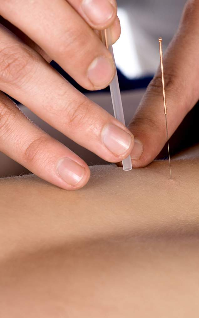 Acupuncture - Évolution Physio